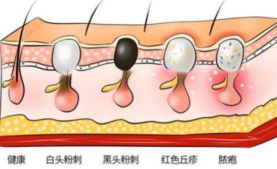 黑头是怎样产生的（黑头的形成原因） 第5张